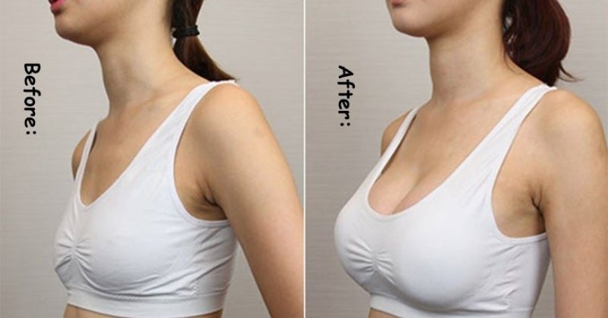 Breast Filler Injections: Before and After Care