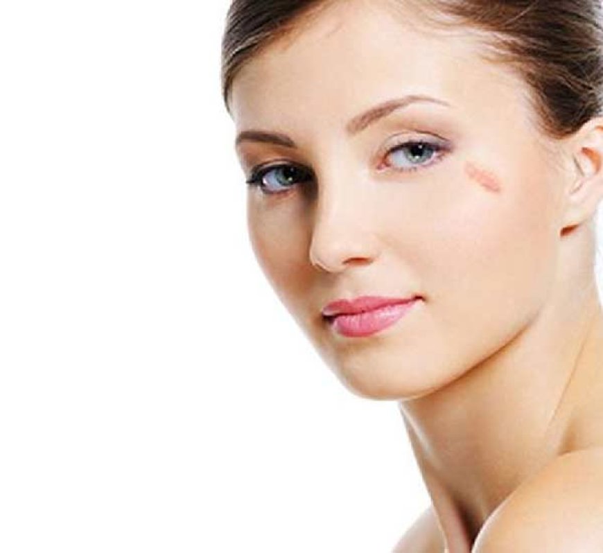 What are the benefits of Birthmarks Removal?