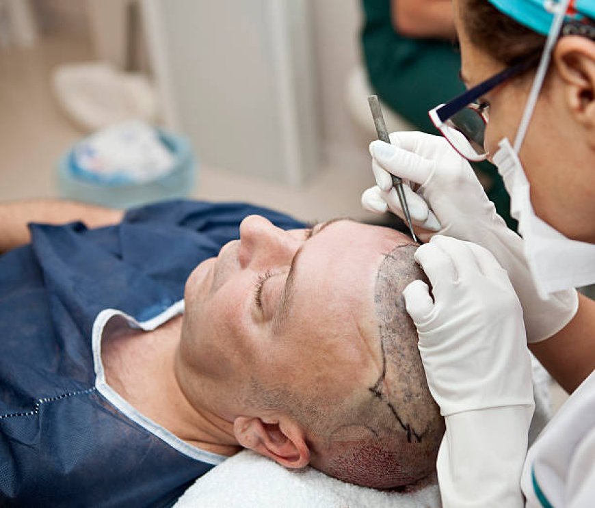 Hair Transplant in Al Ain for Bald Spots After Hair Loss