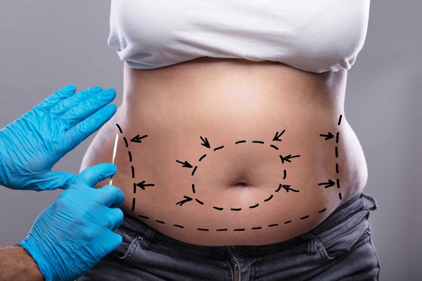 Tummy Tuck Dubai: Understanding Muscle Repair During Surgery