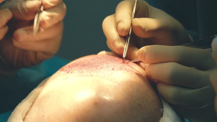 How Can FUT Hair Transplant in Dubai Scars Be Concealed?