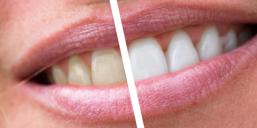 Why Do Some Teeth Respond Better to Professional Whitening Than Others?