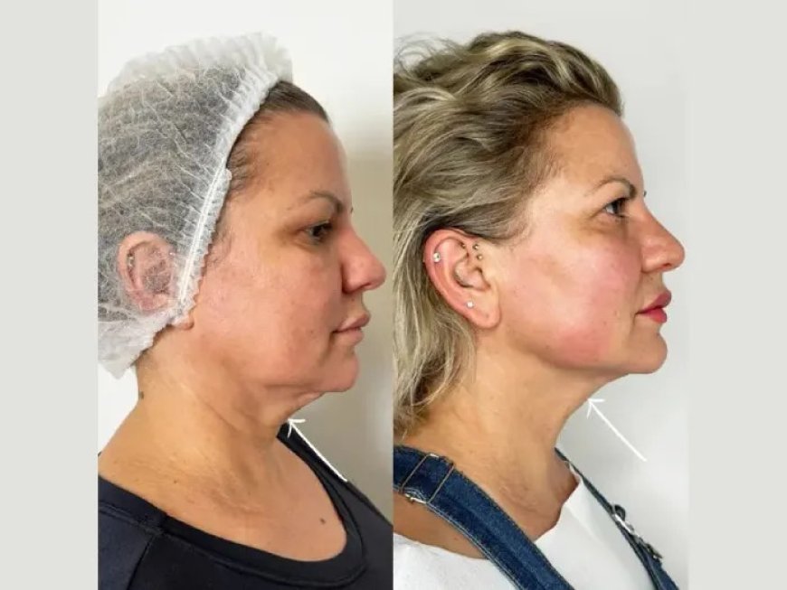 Endolift in dubai for Enhancing Lower Face Definition and Firmness