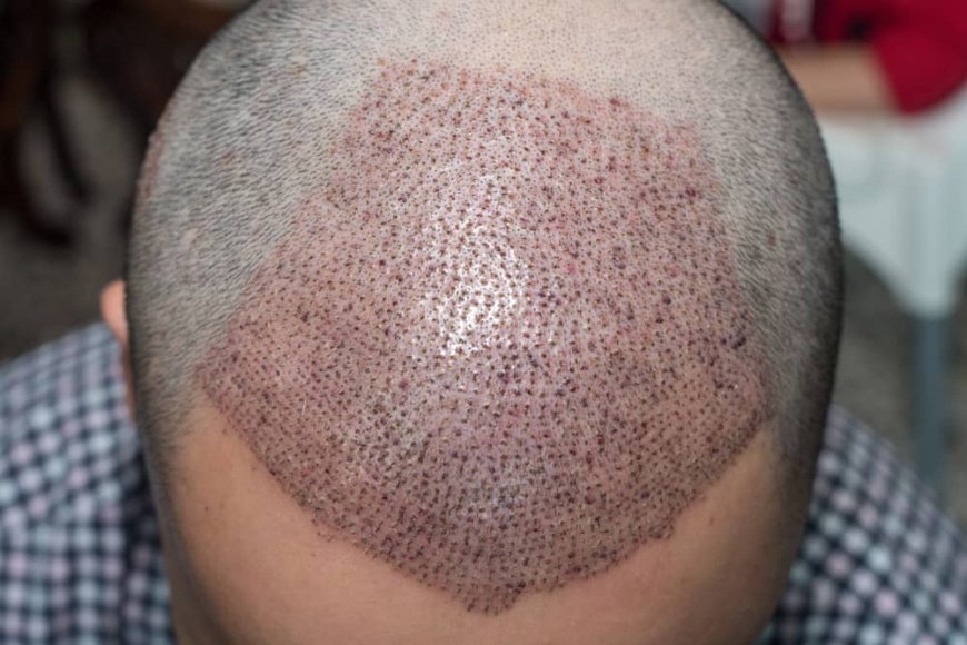 Is FUE Hair Transplant suitable for everyone?