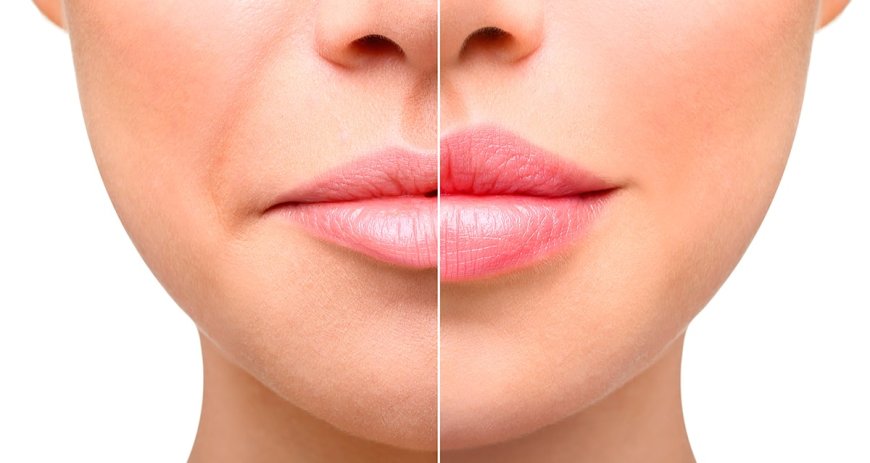 What Factors Affect Lip Augmentation Results in Jeddah?
