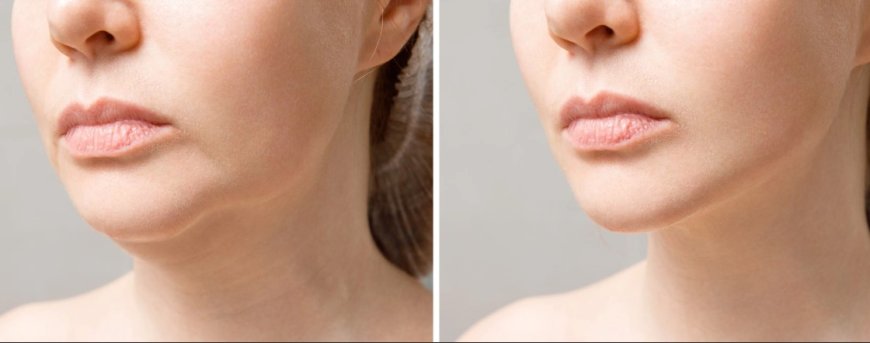 Maintaining Results After Double Chin Removal