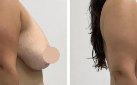 Best Breast Lift Surgeons in Dubai for Elegant Breast Enhancement