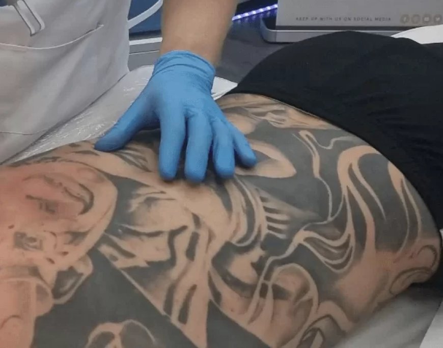What is Picosure Tattoo Removal Treatment?