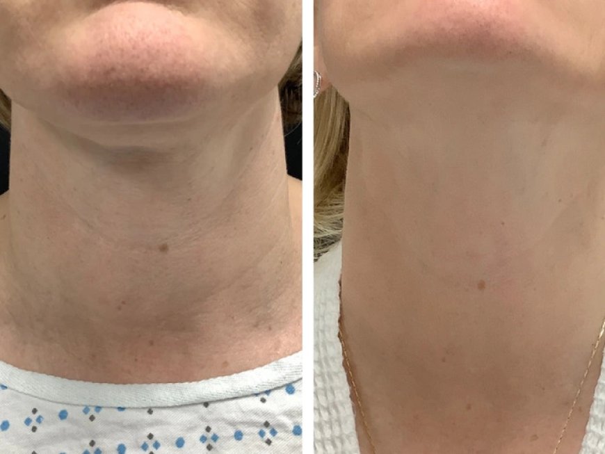 Radiofrequency (RF) Microneedling Treatment in Dubai for Acne Scar Refinement